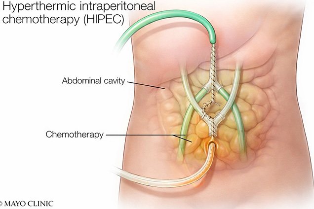 Benefits of HIPEC Surgery